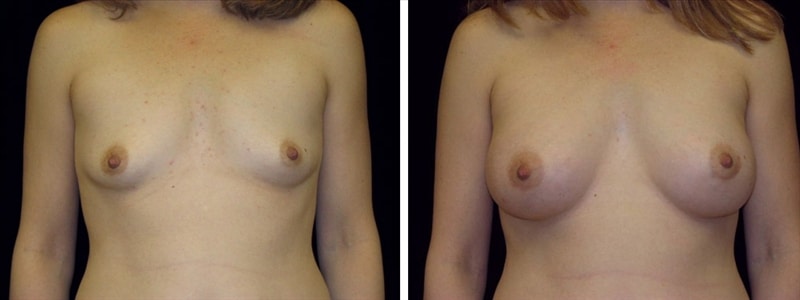 Before and After Breast Augmentation