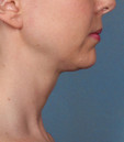 After Kybella treatment in San Francisco