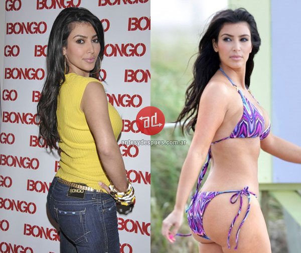 Kim Kardashian Before and After Butt Lift