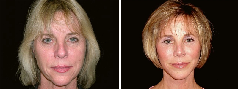 Before and After Facelift surgery in San Francisco