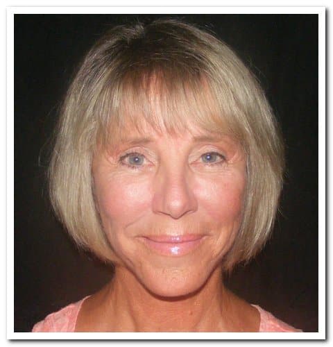 San Francisco Facelift Age 70