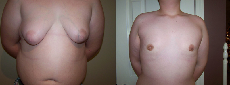Gallery - FTM Surgery - Before and After Treatment - frontal view, male patient 2