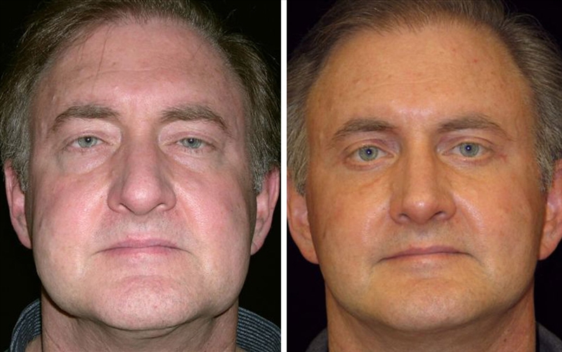 Male facelifts in San Francisco