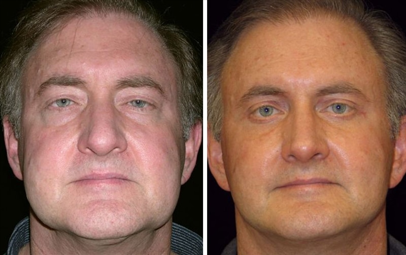 Estiramiento facial masculino en San Francisco