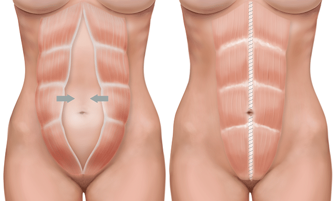 Reparación de diástasis de rectos en San Francisco