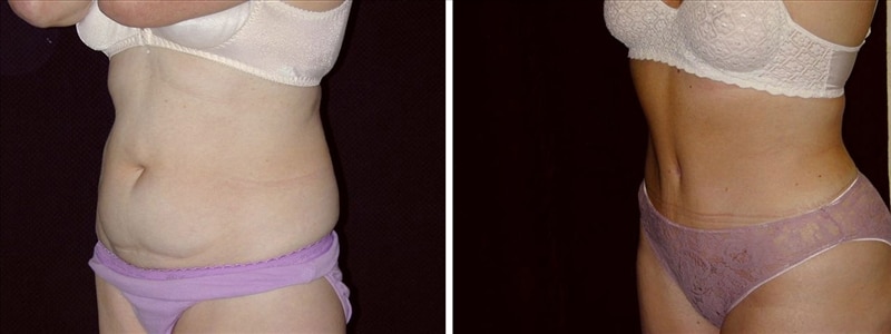 Abdominoplastia con realce de cintura