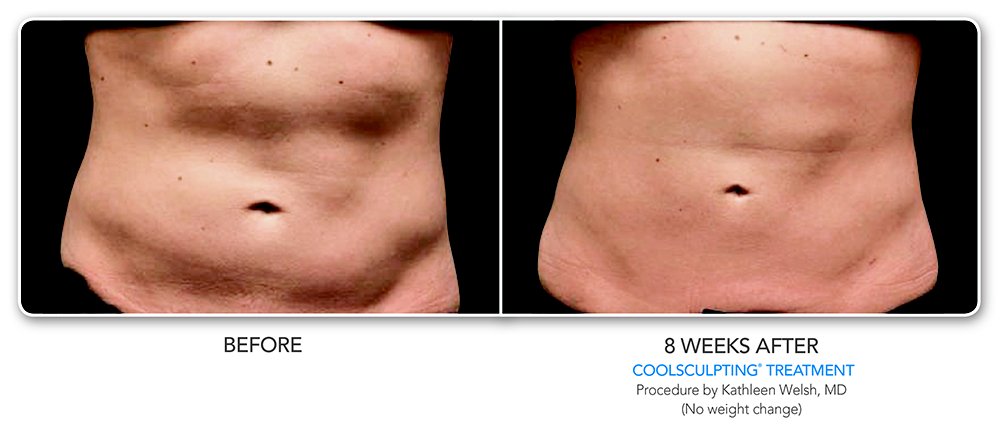 Before After CoolSculpting in San Francisco. 8 week's after. procedure by Kathleen Welsh
