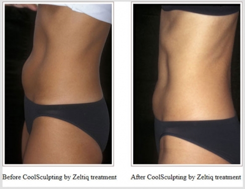 Before and After CoolSculpting Advantage