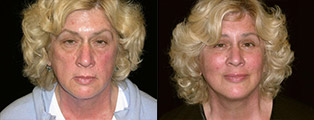 Facelift Before and After in San Francisco