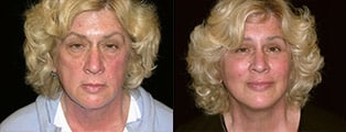 Lifting facial antes y después en San Francisco