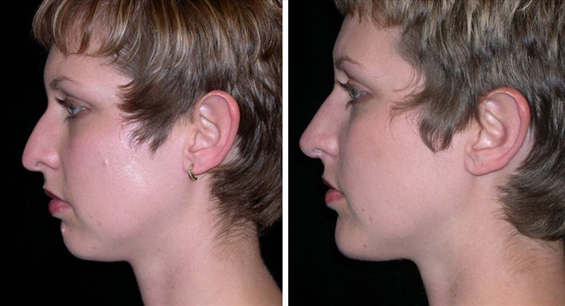 Chin implant and rhinoplasty in San Francisco