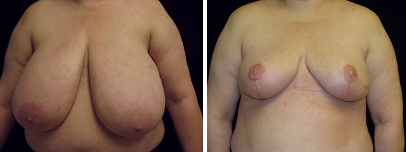 Dr. Miguel Delgado, breast reduction