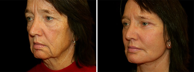 Lifting facial y de cuello en San Francisco