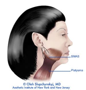 Músculo SMAS para lifting de cuello