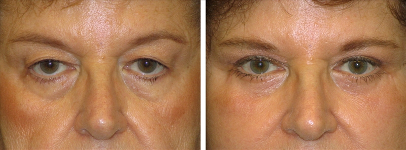 Before and After Blepharoplasty removes tear troughs