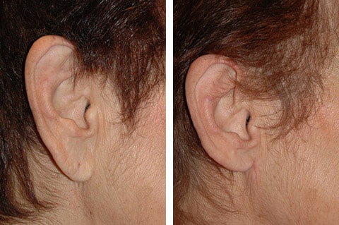 earlobe reduction in San Francisco