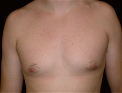 Rhinoplasty Gallery - Patient 39199821 - Image 1