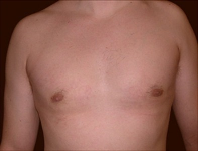 Rhinoplasty Gallery - Patient 39199821 - Image 2