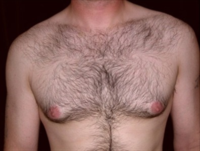 Rhinoplasty Gallery - Patient 39199821 - Image 1