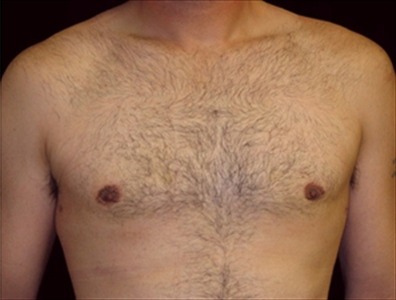 Rhinoplasty Gallery - Patient 39199821 - Image 2