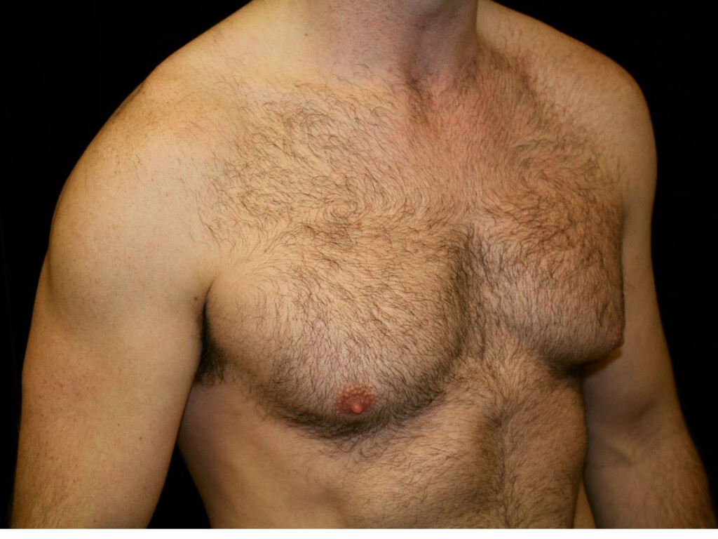 Rhinoplasty Gallery - Patient 39199821 - Image 4