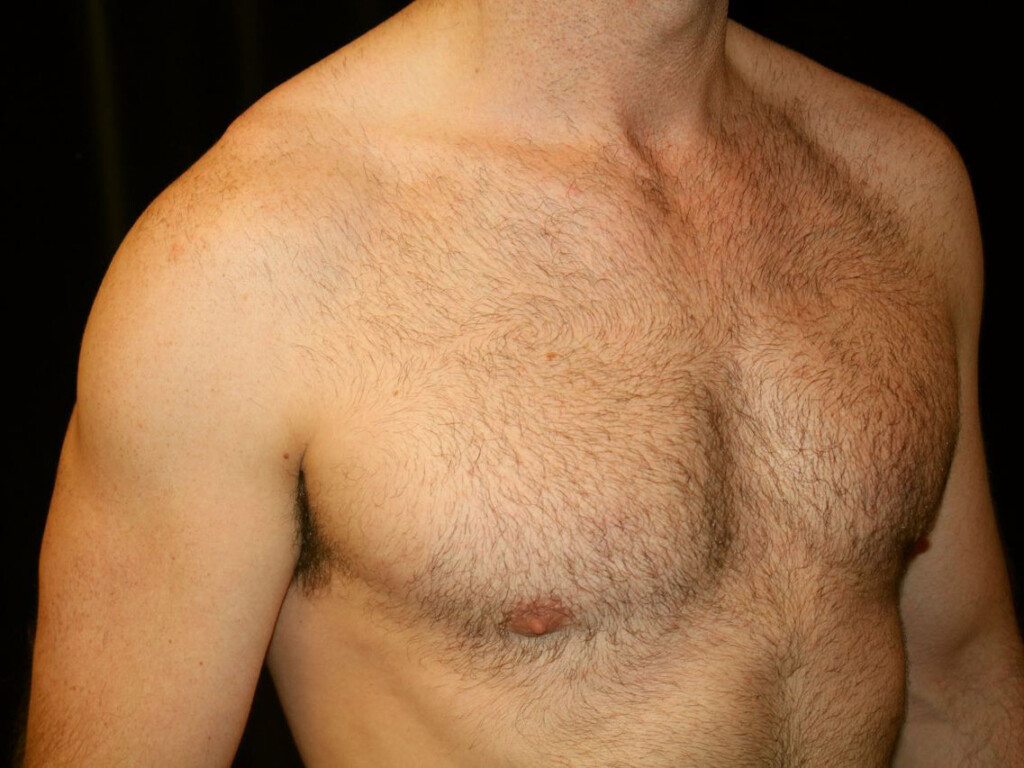 Rhinoplasty Gallery - Patient 39199821 - Image 2