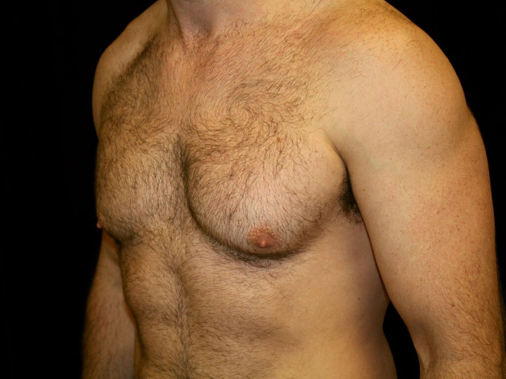 Rhinoplasty Gallery - Patient 39199821 - Image 1