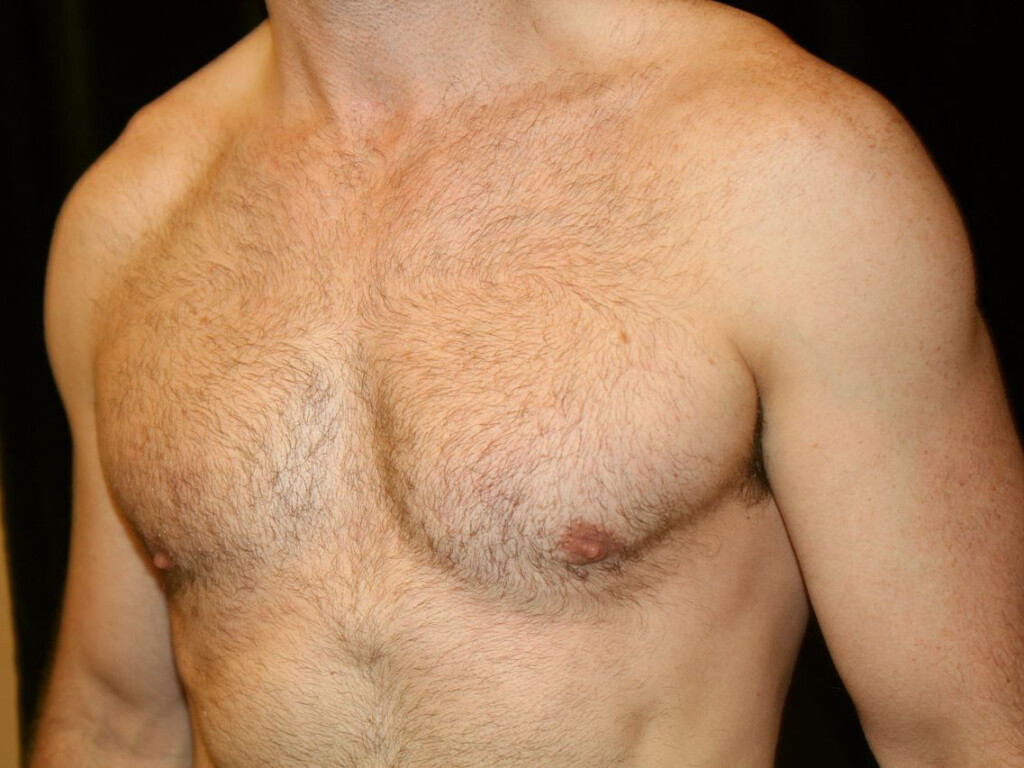 Rhinoplasty Gallery - Patient 39199821 - Image 2