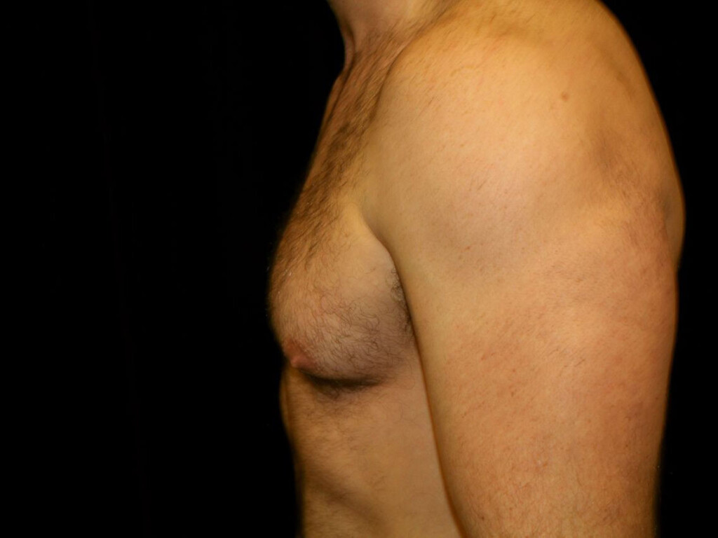 Rhinoplasty Gallery - Patient 39199821 - Image 1