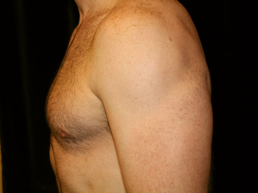 Rhinoplasty Gallery - Patient 39199821 - Image 2