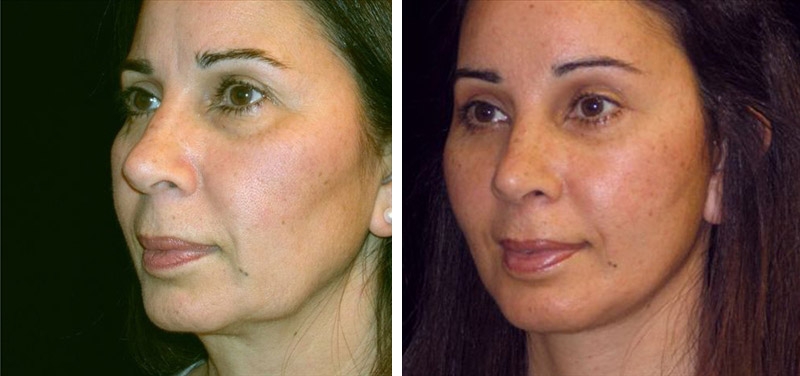 Antes y después de la cirugía de estiramiento facial