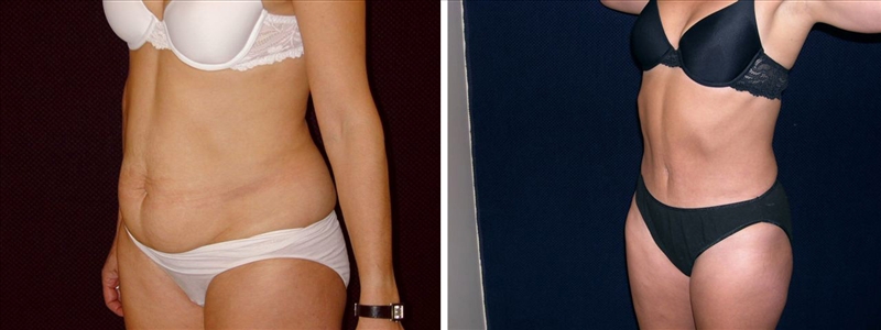 Antes y después de la abdominoplastia