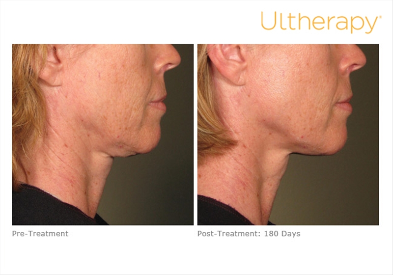 Ultherapy 019