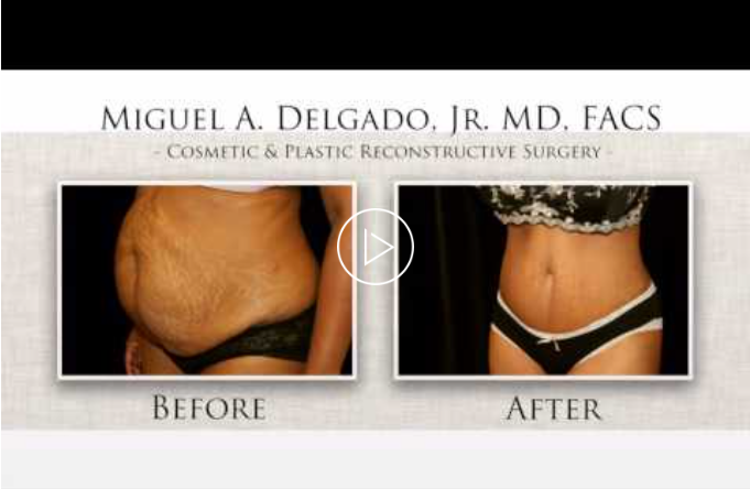 LIVE SURGERY | Brazilian Butt Lift (BBL) |Tummy Tuck Part 5 of 5 Before and After Photos