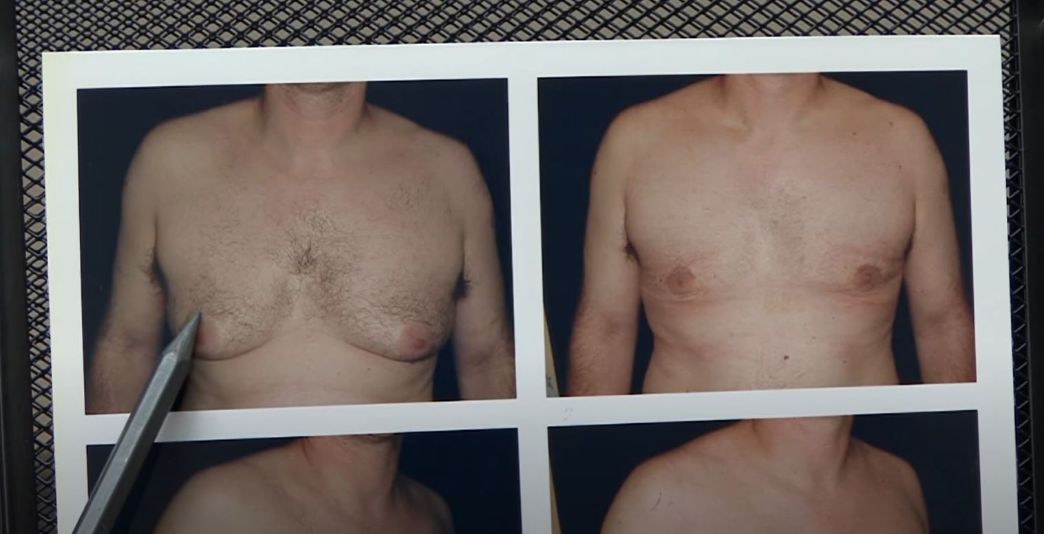 WHAT IS GYNECOMASTIA? | LISTEN TO EXPERT DR. DELGADO, BOARD CERTIFIED DOCTOR, EXPLAIN.