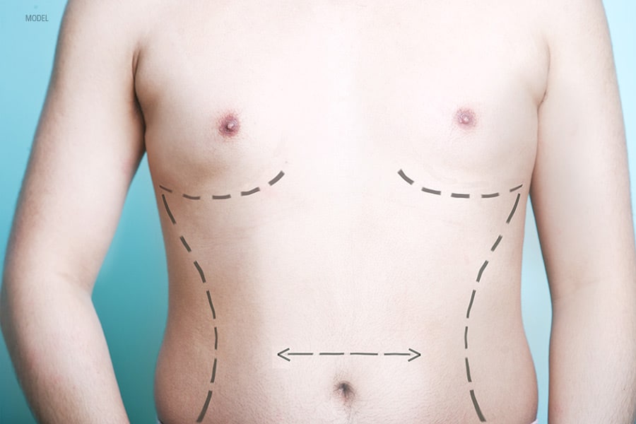 A man's body is marked up prior to plastic surgery for recontouring.