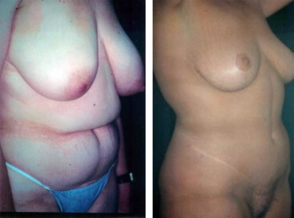 Mommy makeover before and after photo pt 4