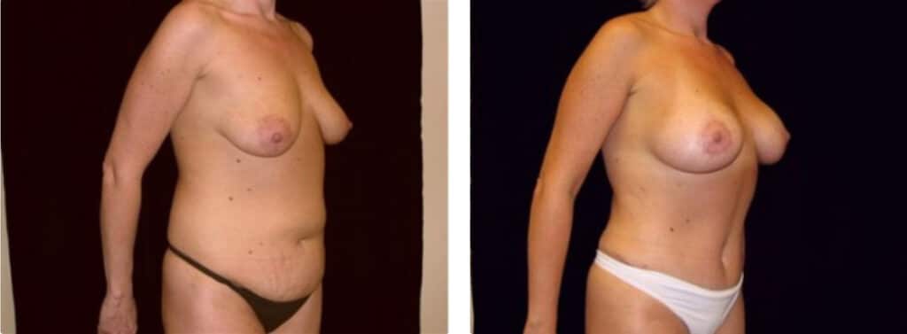Mommy makeover before and after photo waist enhancement 