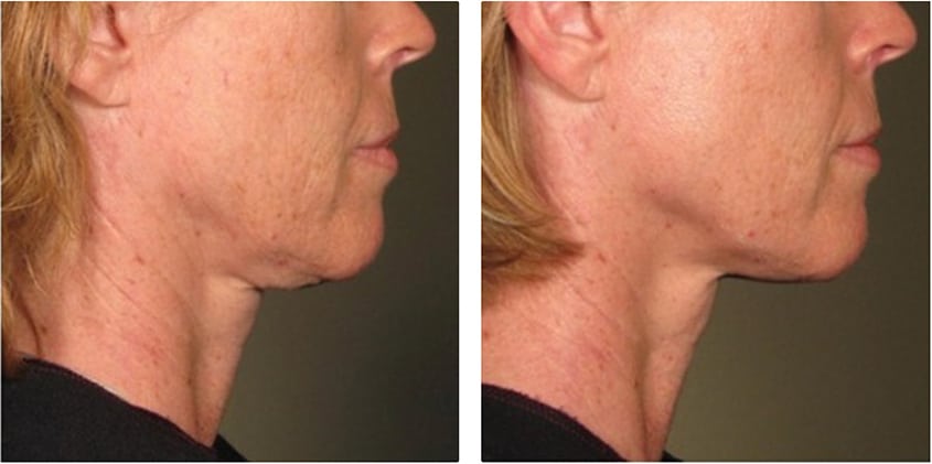 A woman undergoes a non-surgical neck lift.