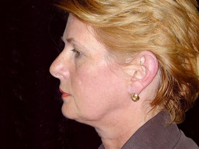 Preparing for direct neck lift surgery