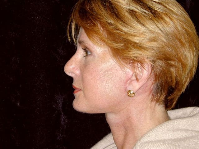Dr. Delgado's patient after a facelift and neck lift.