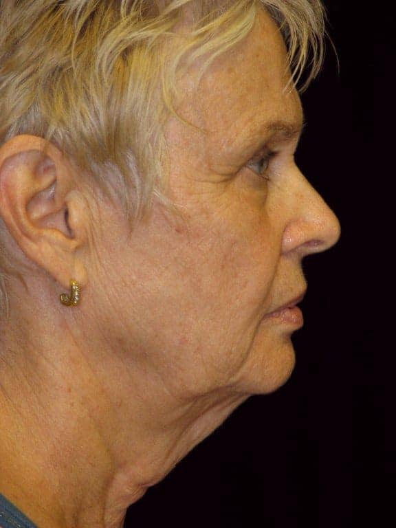 Patient with a turkey neck, loss of neck angel, severe jowls, excess skin and fat tissues.