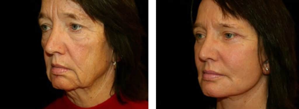 Advanced facial aging due to weight loss- Ozempic medication causing "Ozempic face"