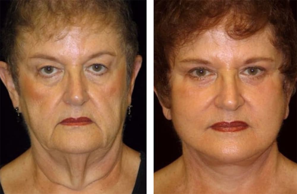 San Francisco plastic surgeon, Dr. Delgado, performs a full facelift and fat injections for fat volume replacement.