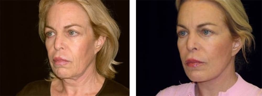 Patient Before and after photo