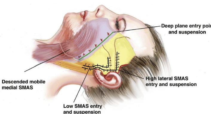 Deep plane facelift entry point vs SMAS facelift.