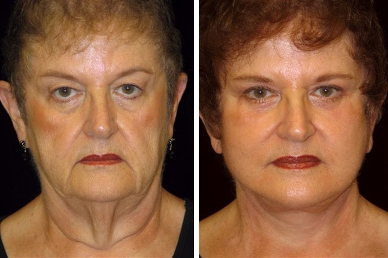Deep plane facelift patient before and after at 1 year.