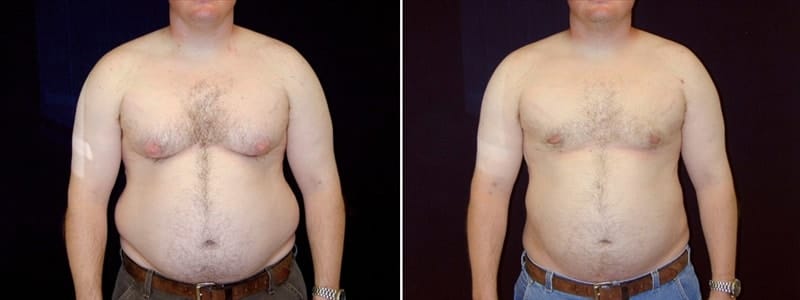 An illustration depicting the anatomy of male breast tissue, highlighting excess breast tissue.