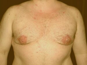 The patient after Stage 1 - Breast gland exdision and liposuction.