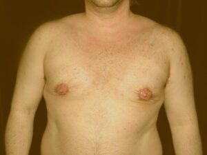 The patinet after Stage 2 - peri-areola skin excision.